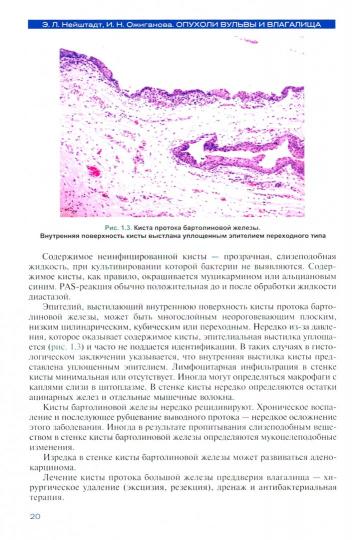 Опухоли вульвы и влагалища