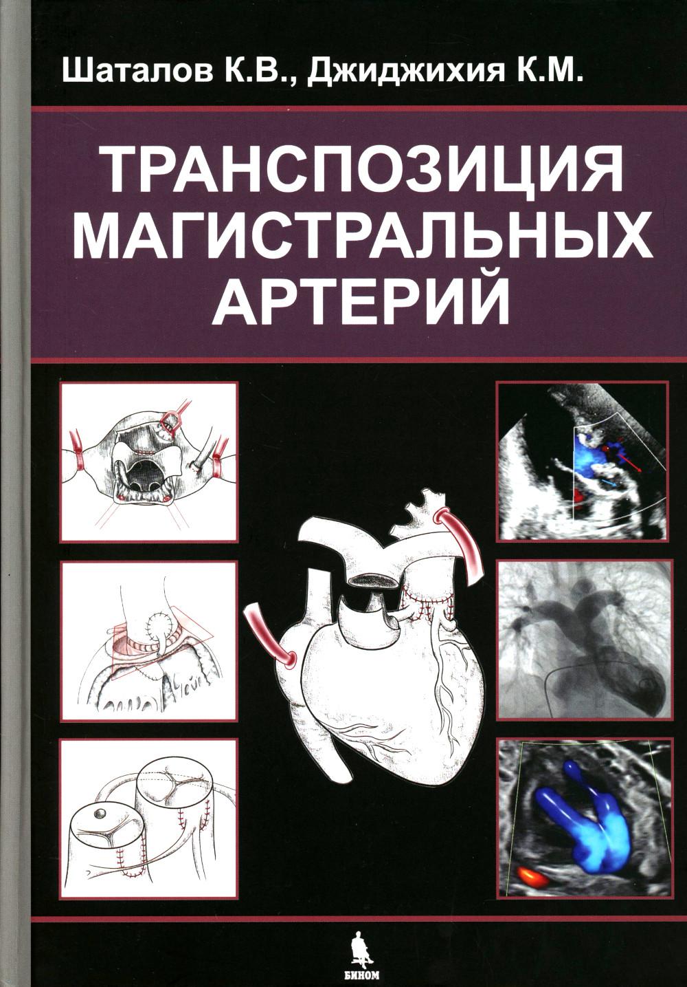 Транспозиция магистральных артерий
