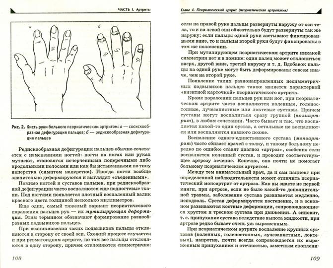 Артрит.Избавляемся от болей в суставах