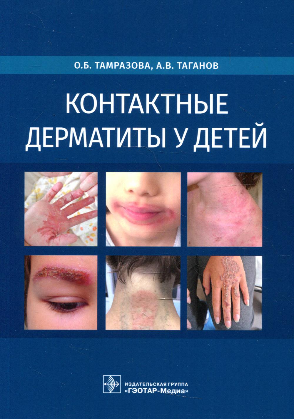 Контактные дерматиты у детей / О. Б. Тамразова, А. В. Таганов. — Москва : ГЭОТАР-Медиа, 2022. — 256 с. : ил.