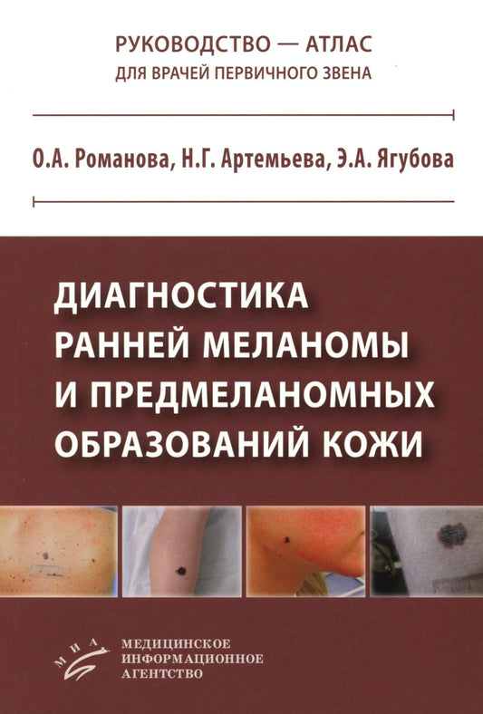 Диагностика ранней меланомы и предмеланомных образований кожи: Руководство - атлас для врачей первичного звена