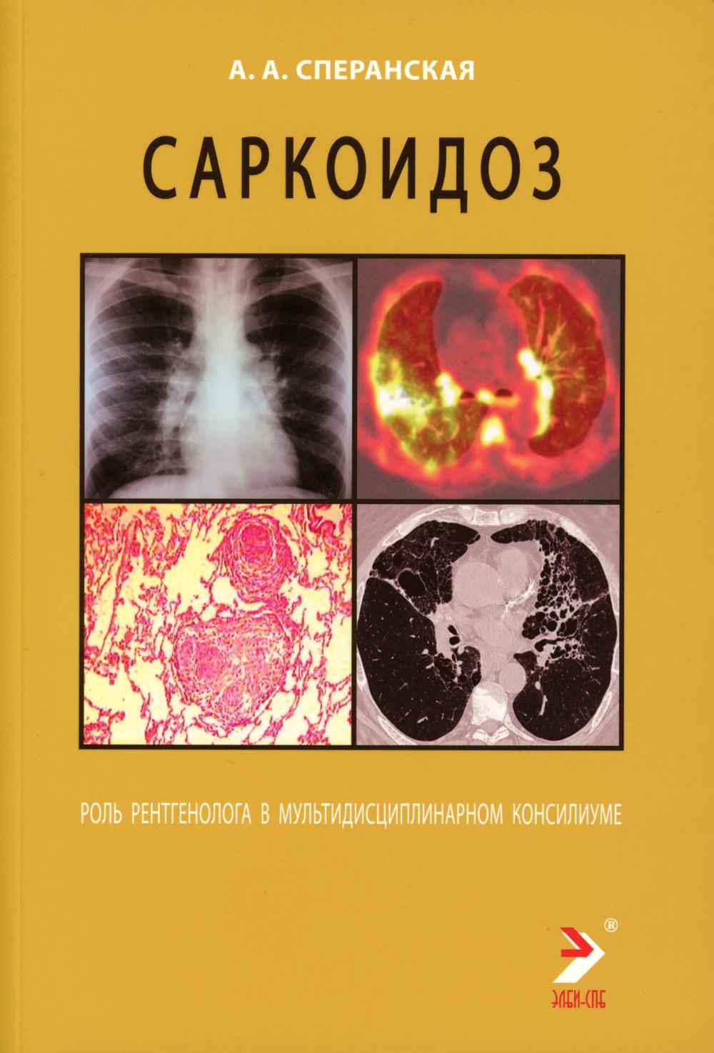 Саркоидоз. Роль ренгенолога в мультидисциплинарном консилиуме