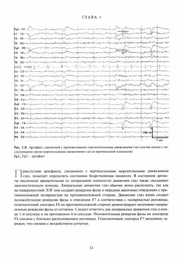Клиническая интерпретация электроэнцефалографии