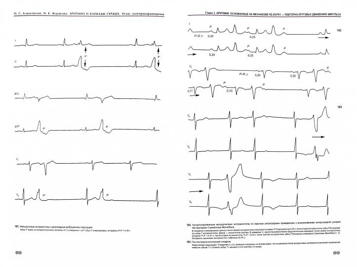 Аритмии и блокады сердца: атлас электрокардиограмм. 5-е изд., перераб. и доп