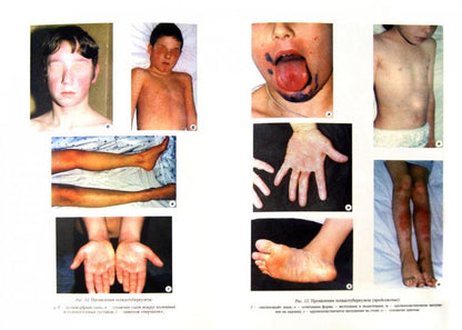 Инфекционные болезни у детей: Учебник для студентов медицинских ВУЗов. 5-е изд., испр.и доп