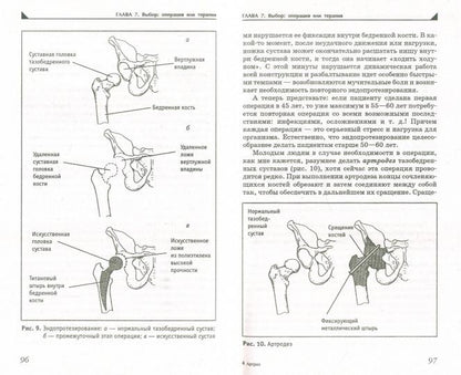 Артроз.Избавляемся от болей в суставах