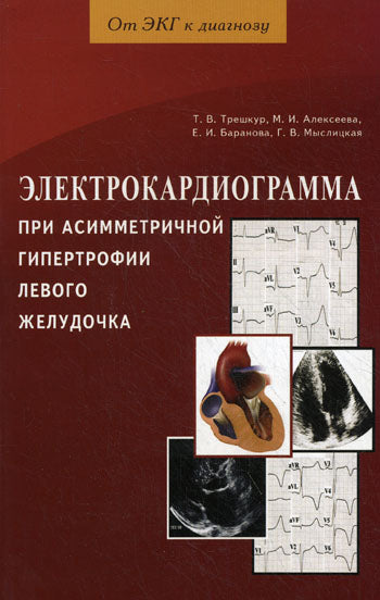 Электрокардиограмма при асимметричной гипертрофии левого желудочка