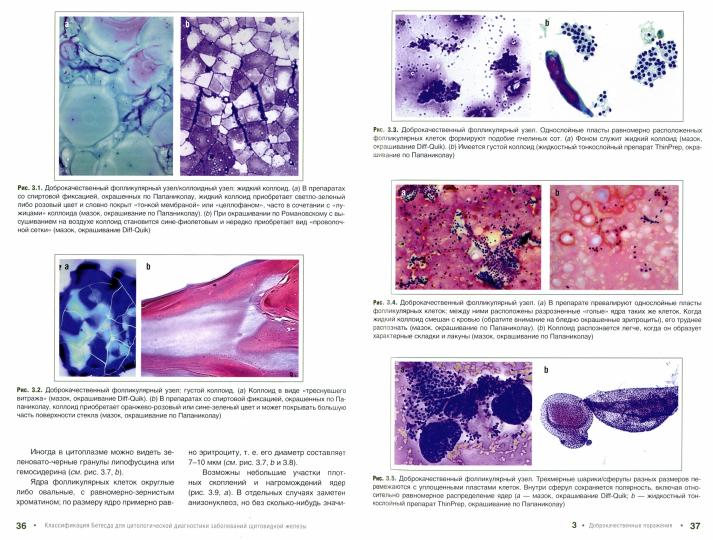 Классификация Бетесда для цитологических заболеваний щитовидной железы: терминология, критерии и пояснения