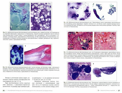 Классификация Бетесда для цитологических заболеваний щитовидной железы: терминология, критерии и пояснения